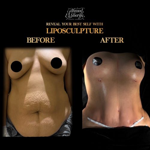 تجارب نحت الجسم والشفط في الرياض